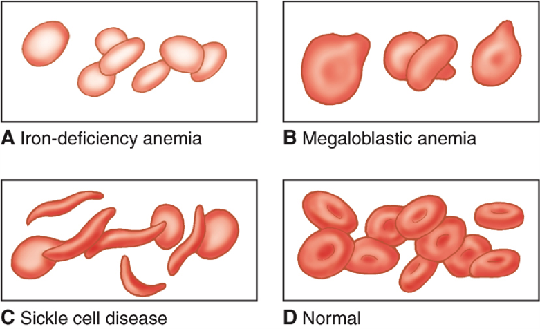 آزمایشات خونی برای شناسایی کم خونی مینور