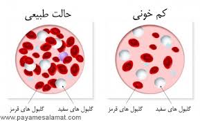 کم و خونی و علائم آن