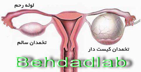 کیست تخمدان